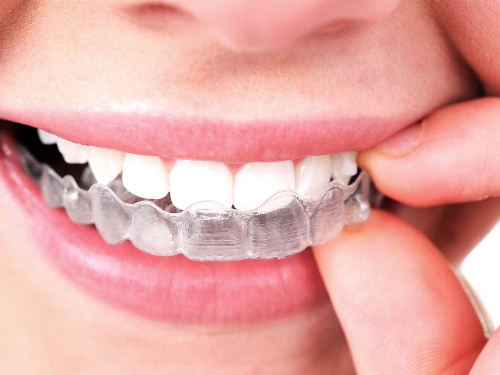 invisalign audy dental